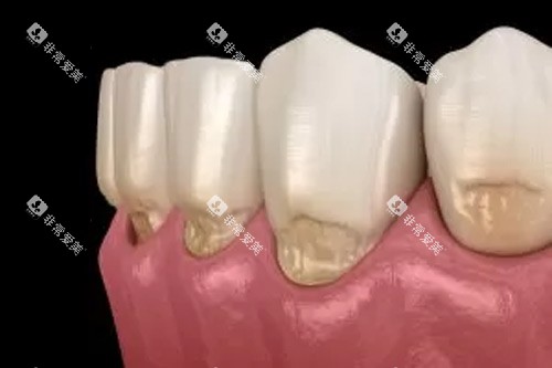 牙齿楔状缺损示意图