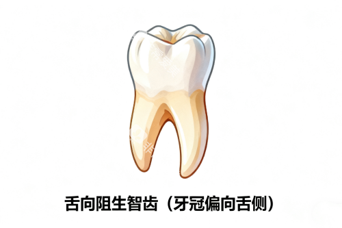 舌向阻生智齿展示图