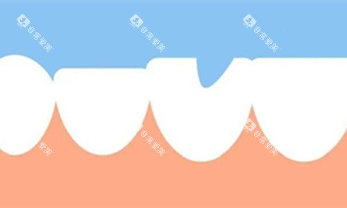 牙齿缺失一块展示图