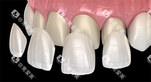牙齿贴面