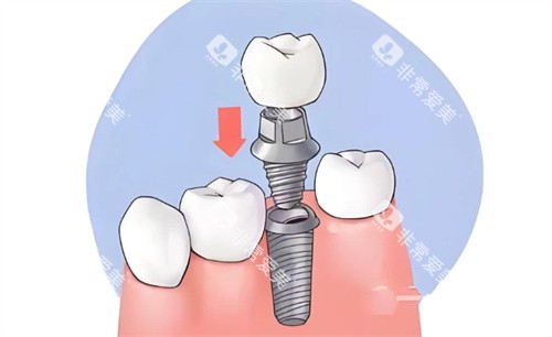 种植牙手术动画示意图