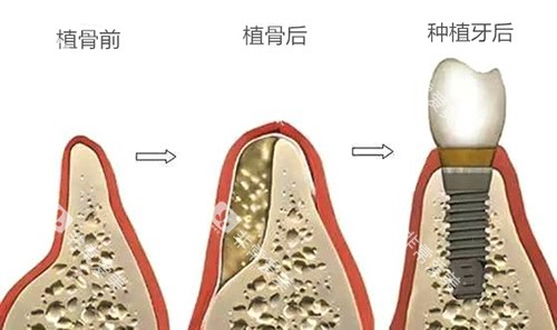 种植牙植骨前后于种植牙后漫画图