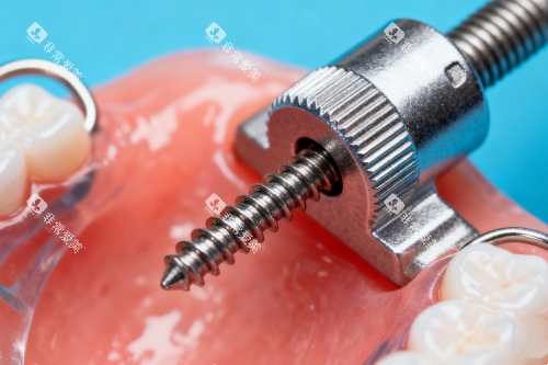 牙齿保持器安装图片展示