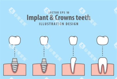 牙齿种植过程图示意图