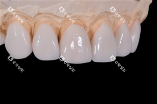 牙齿贴面修复展示