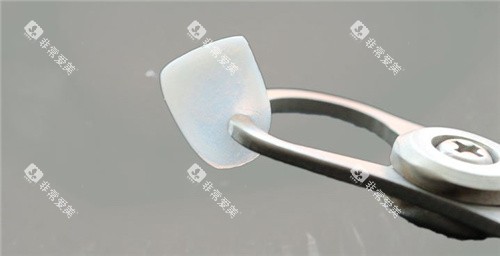 超薄牙齿贴面