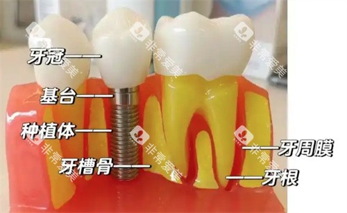 种植牙实拍过程