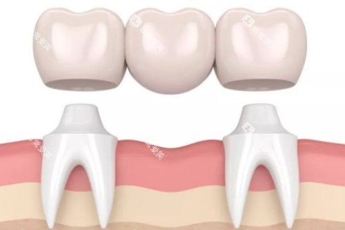镶牙卡通展示图