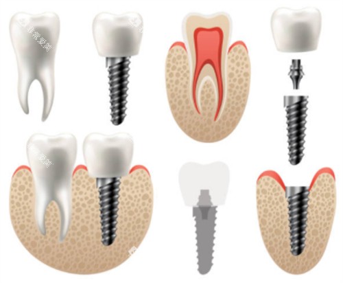 牙齿种植前后对比图