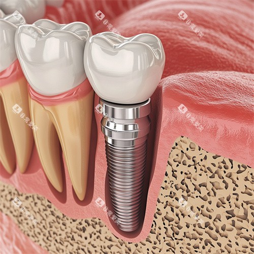 牙齿种植牙侧位解剖动画示意图