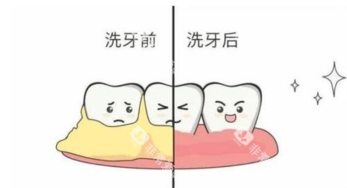 洗牙前后的对比