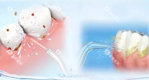 洗牙卡通示意图