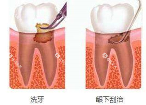 洗牙和龈下刮治对比示意图