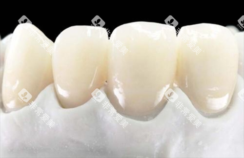 全瓷牙前牙展示