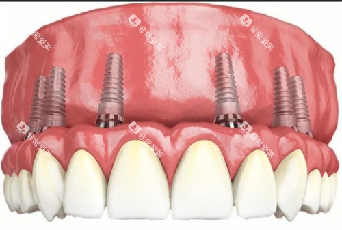 全口种植牙动画示意图