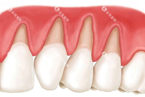 牙齿楔状缺损卡通图