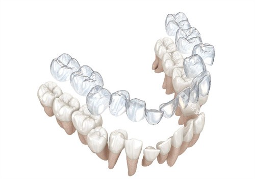 隐形矫正牙齿过程