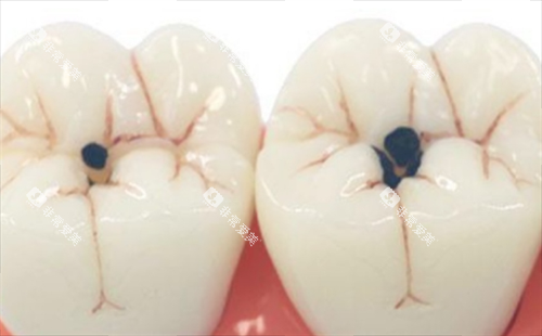 龋齿图片：牙齿模型展示