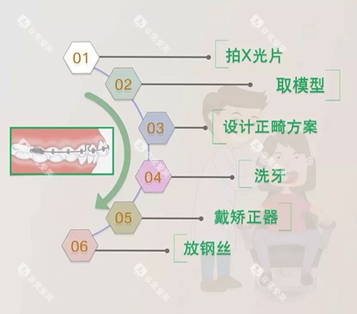 牙齿矫正流程