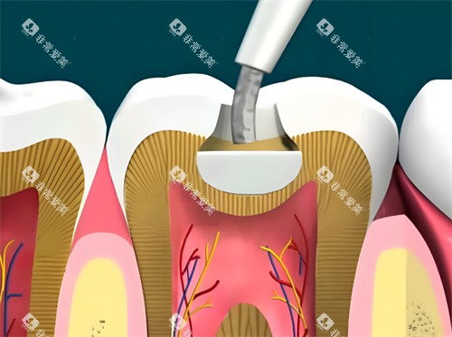 树脂补牙动画展示