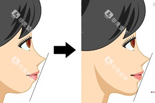 下巴后缩卡通图