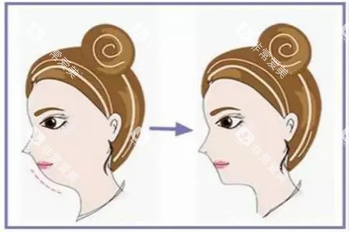 假体垫下巴侧面示意图