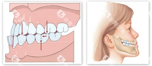 下巴内缩内部展示动画图
