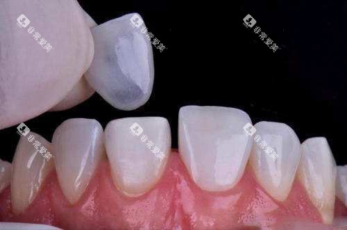 牙齿贴面过程