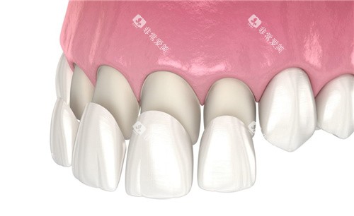 前牙四颗牙齿贴面