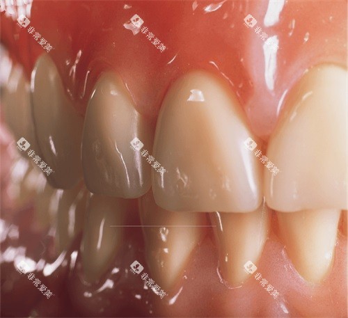 吸附性义齿牙齿细节展示图