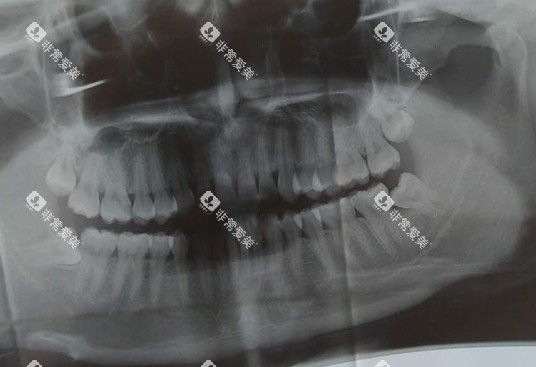 口腔牙齿ct照片