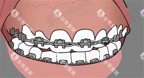 牙齿矫正动画图