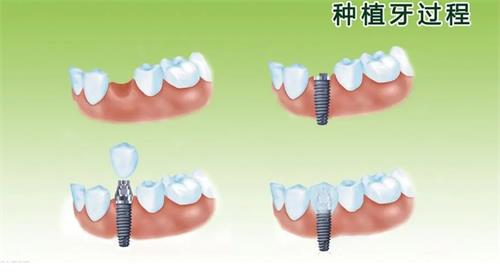 种植牙的过程