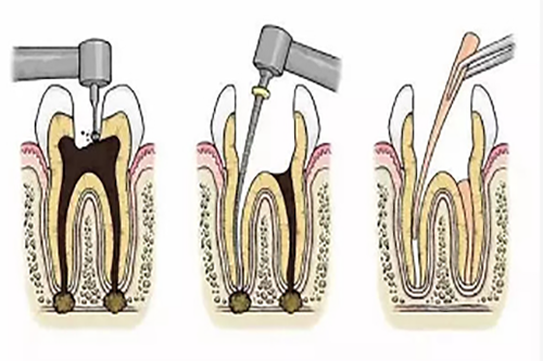 根管治疗步骤1