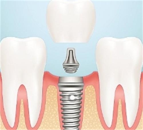 种植牙的组成部分