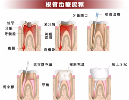 根管治疗流程