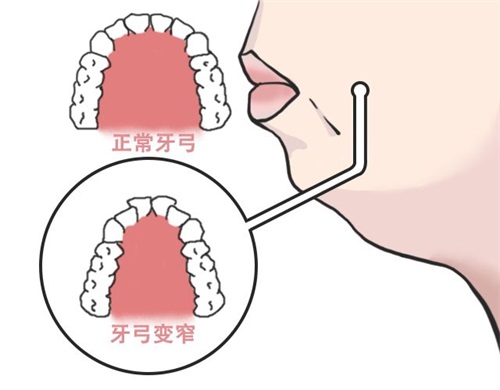 牙齿矫正扩牙弓目的