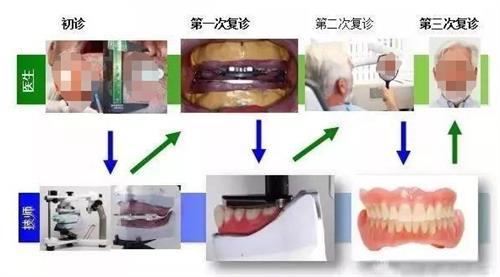 吸附式假牙的制作过程