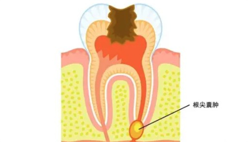 什么是根尖囊肿
