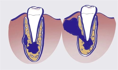 牙齿根尖囊肿