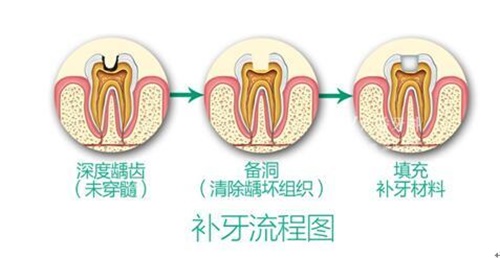 补牙过程图