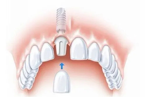 单颗种植牙安装牙冠卡通示意图
