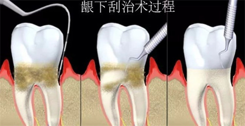 龈下刮治过程