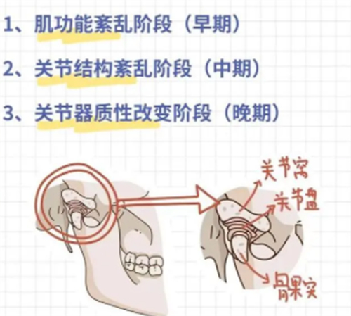 不同程度颞下颌关节紊乱