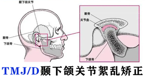 颞下颌关节紊乱矫正