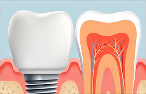 种植牙齿内部示例图