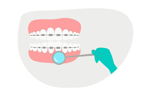牙齿牙套矫正检查
