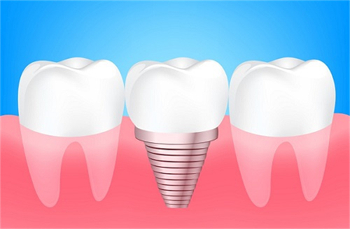 三颗种植牙齿示例图