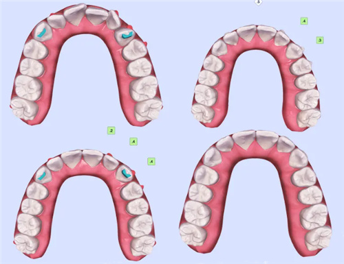 牙齿矫正模拟结果对比