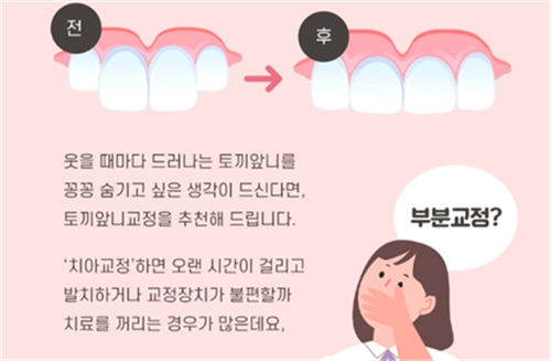 门牙突出矫正后对比图